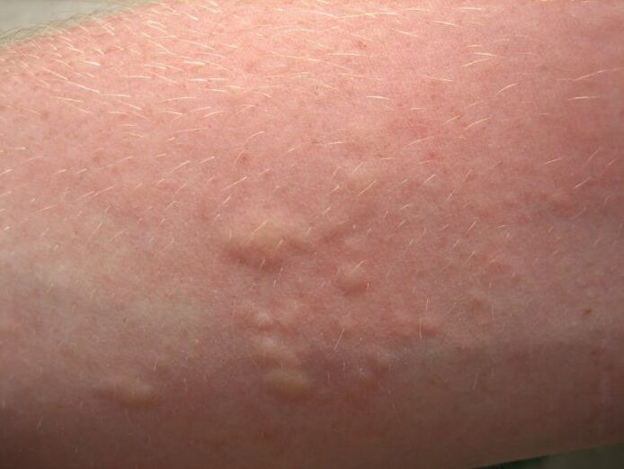 Juckende allergische Hautausschläge können Symptome einer Ascariasis sein