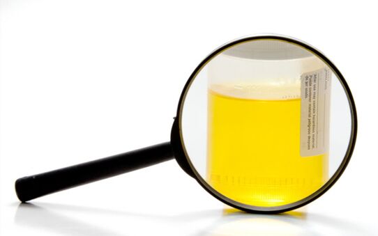 Urinanalyse zur Diagnose von Bilharziose