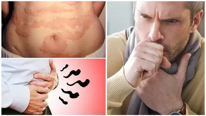 Allergien, Husten und Blähungen sind Anzeichen für eine Schädigung des Körpers durch Würmer