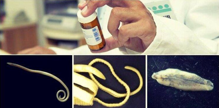 Arten von Würmern und eine medizinische Methode, sie loszuwerden